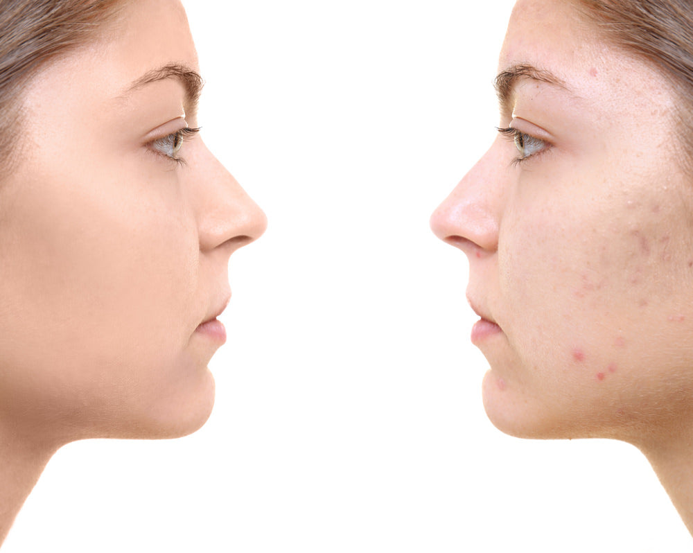 krathen hormonal acne